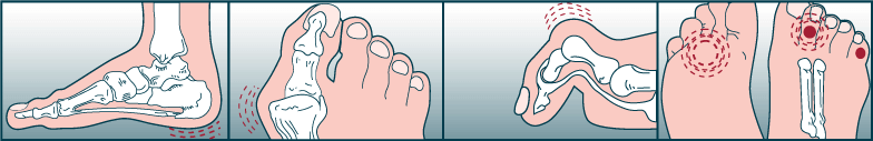 foot problems 1